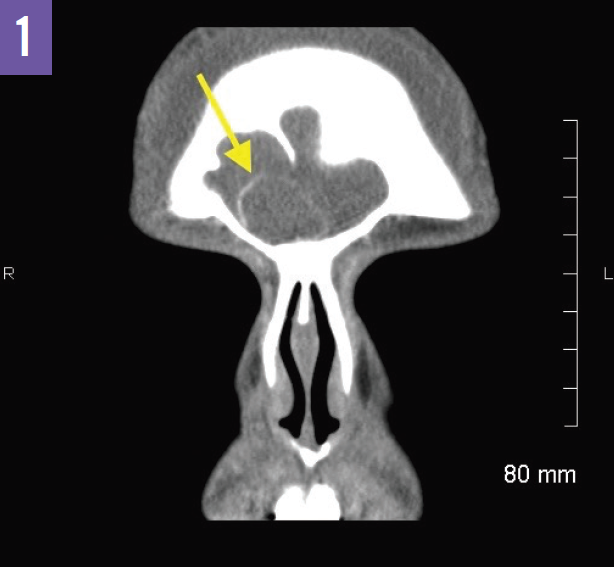 Pott Puffy Tumor Consultant360